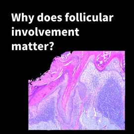 Why does follicular involvement matter?